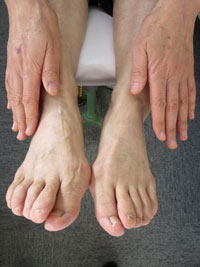 足 ヘバーデン 結節 手が変形してモノが持てない…知られざる病「ヘバーデン結節」の恐怖（週刊現代）