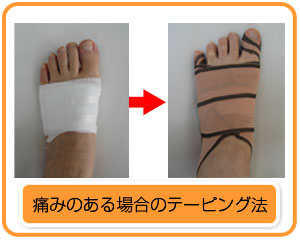 足指の疲労骨折及び変形 笠原巖の 足の痛み 専門サイト