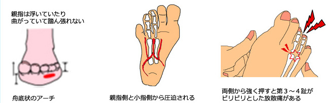 原因:外反母趾や浮き指、ハイアーチの人で足裏の指の付け根が「舟底状の逆アーチ」になっていて、第3趾と第4趾を地面に打ち付けた為