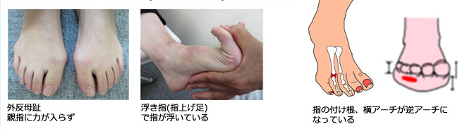 原因:外反母趾や浮き指などによる足指の力不足が原因となり、
第3～4趾に荷重(重力による負担)が集中したため
