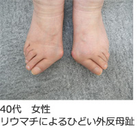 40歳女性、リウマチによるひどい外反母趾