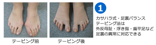 カサハラ式足裏バランステーピング法は外反母趾、浮き指、扁平足など足裏の異常に対応できる
